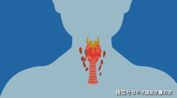 甲亢病人的饮食宜-甲亢患者饮食上应注意限制