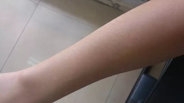 成人湿疹饮食_成人湿疹饮食吃什么好_成人湿疹饮食注意事项