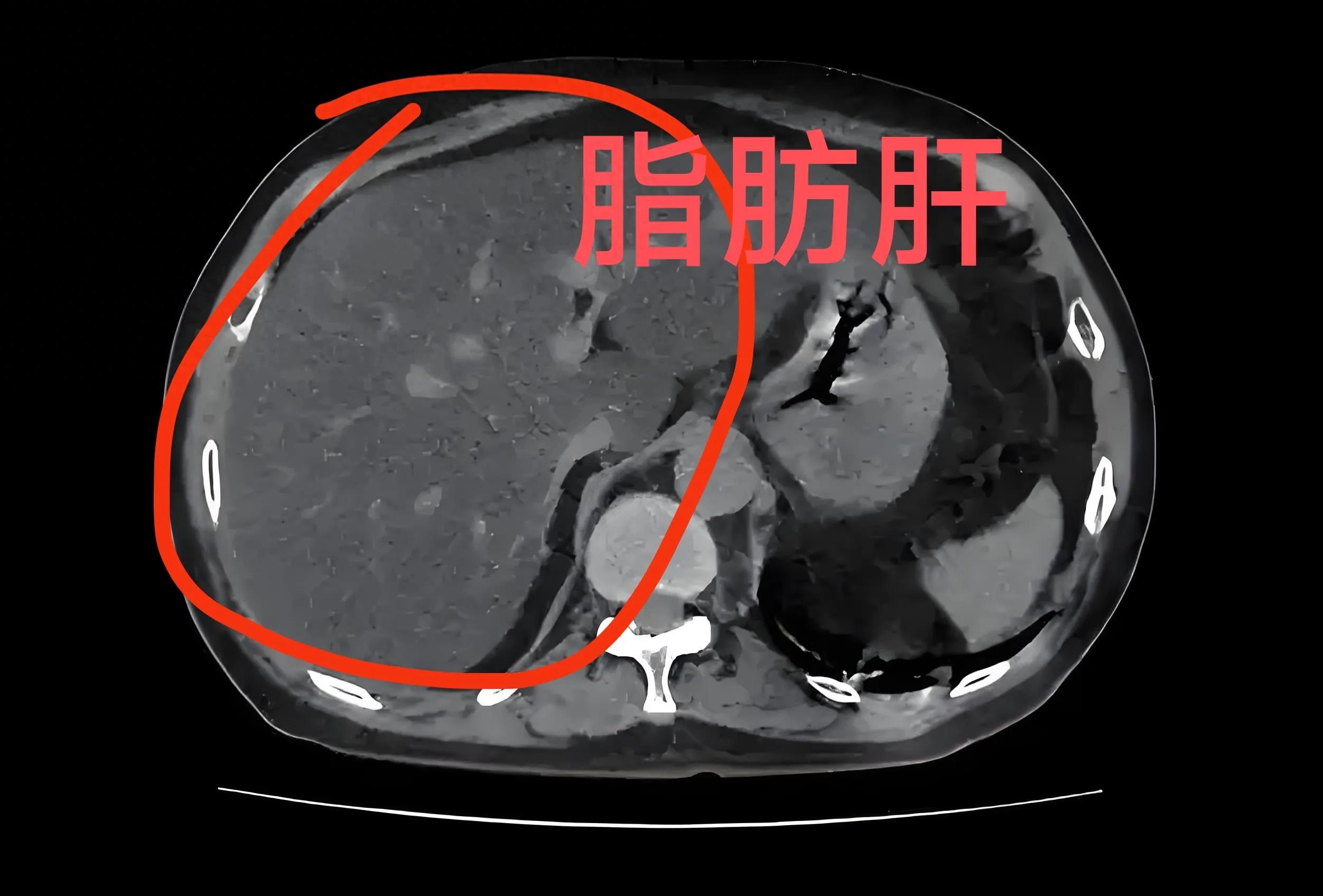 肝脂肪饮食注意事项_脂肪肝怎么冶疗饮食怎么注意呢_脂肪肝治疗食谱