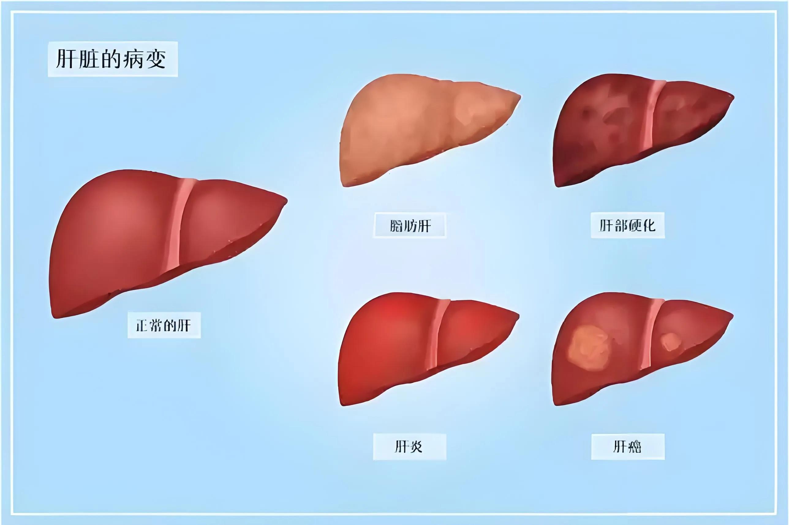 肝脂肪饮食注意事项_脂肪肝怎么冶疗饮食怎么注意呢_脂肪肝治疗食谱