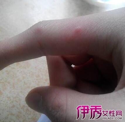水痘饮食吃什么-出水痘饮食禁忌